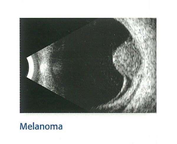 KEELER ACCUTOME B SCAN PLUS WITH LAPTOP - Image 3