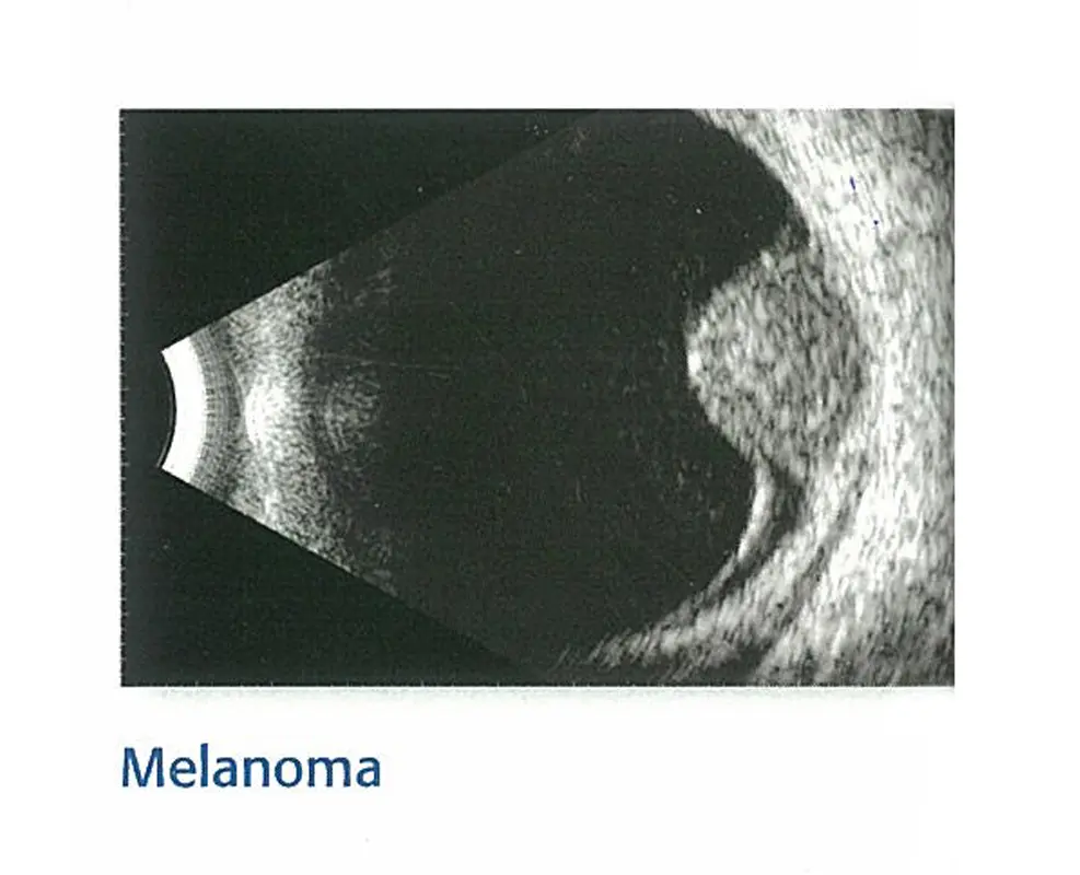 KEELER ACCUTOME B SCAN PLUS WITH LAPTOP - Image 3